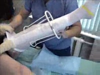 Эластичная компрессия после лечения необходима