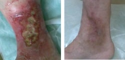 Варикозное расширение вен на ногах после операции фото thumbnail