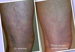 Вены на ногах лечение до и после