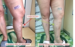 Вены на ногах лечение до и после thumbnail